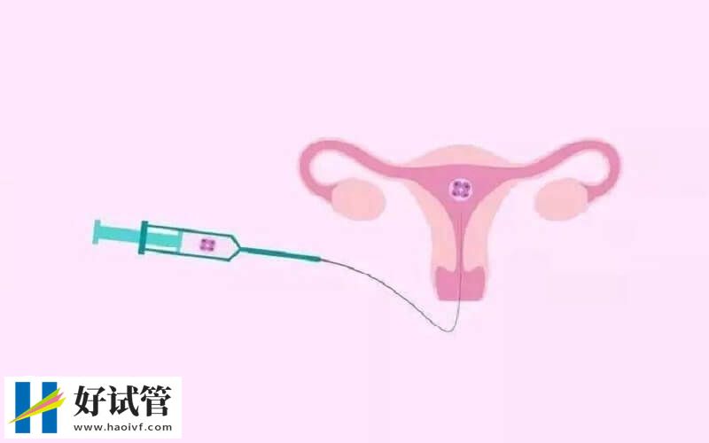 宫腔灌注的流程是什么(图1) 宫腔灌注的流程是什么(图1)